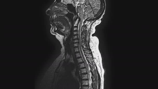 Postoperativ omfattande MRT av kvinnliga organ för detektion av metastaser — Stockvideo