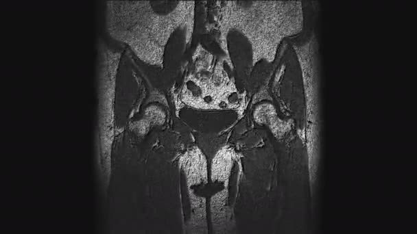 Resonancia magnética voluminosa postoperatoria de órganos femeninos para la detección de metástasis — Vídeo de stock
