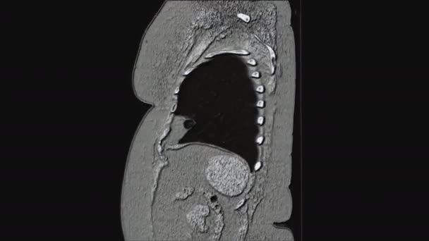 RM a colori voluminosi dei polmoni e dei bronchi, diagnosi di malattia respiratoria virale o covid-19 — Video Stock