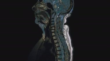 Metastaz tespiti için kadın organlarının çok renkli MR 'ı.