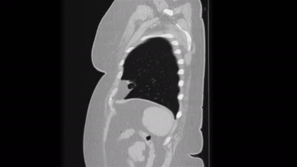 Čištěná MRI plic a průdušek, diagnóza virového respiračního onemocnění — Stock video