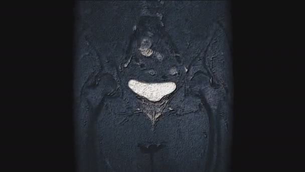 전이를 탐지하기 위한 수술 후의 거대 한 컬러 MRI — 비디오