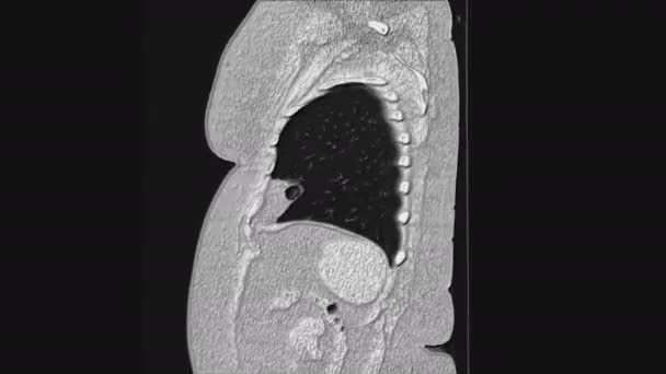Обширная МРТ легких и бронхов, диагностика вирусных или ковидовых заболеваний органов дыхания-19 — стоковое видео