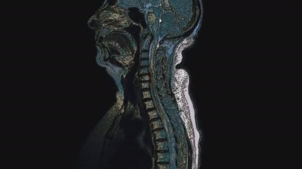 전이를 탐지하기 위해 수술 후 다발적으로 채색 된 여성 장기 MRI — 비디오