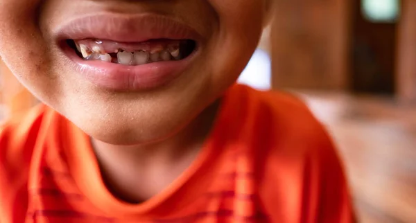 Bebé Biberón Caries Dental Problema Alimentar Los Niños Biberón — Foto de Stock