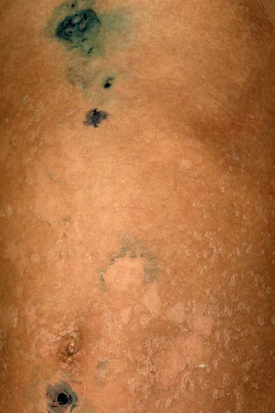 Bir çocuğun vücudunda impetigo belirtileri.