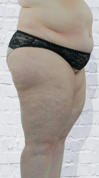 Kvinna med fetma visar de drabbade kroppsdelarna — Stockfoto