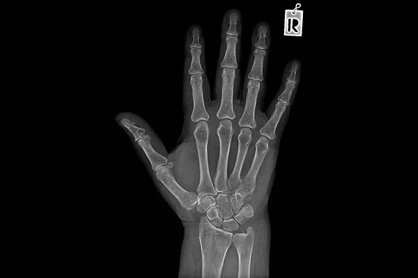 Imagen de rayos X negativos de la mano humana Reumatismo — Foto de Stock
