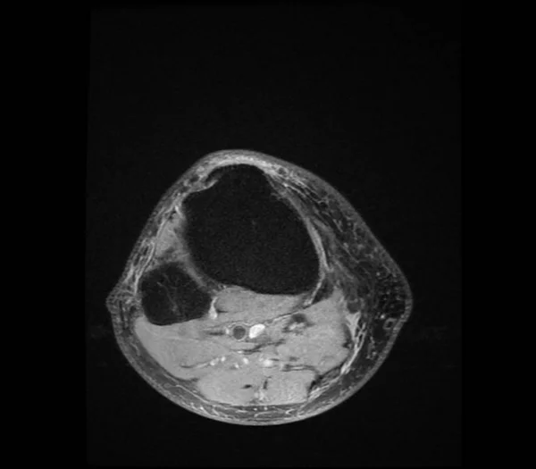 Від'ємні X-ray образ людини коліно ревматизм — стокове фото