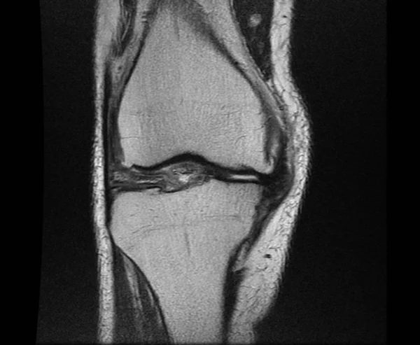 Negatieve X ray beeld van menselijke knie reuma Stockfoto