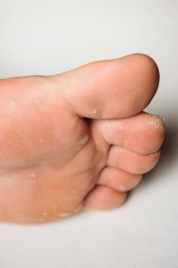 Mantar enfeksiyonu insan ayağının tırnaklarında beyaz arka planda.