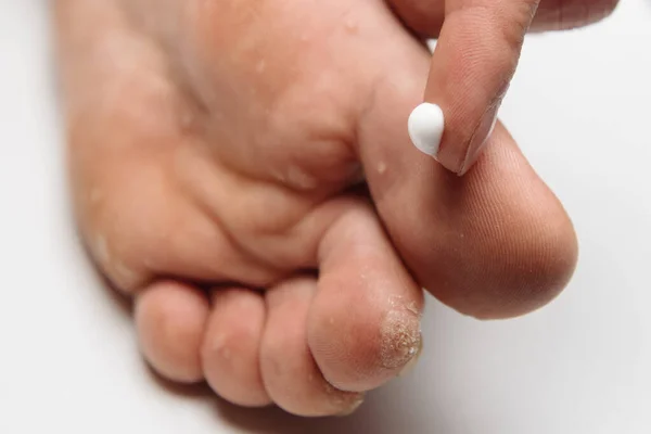 Man applying cream for athletes foot treatment — Stock Photo, Image