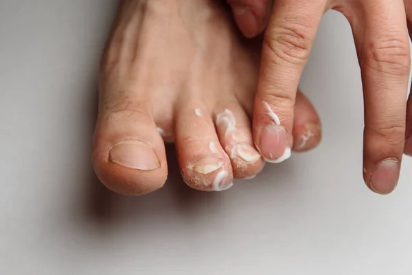 Человек нанесение крема для спортсменов лечение ног — стоковое фото