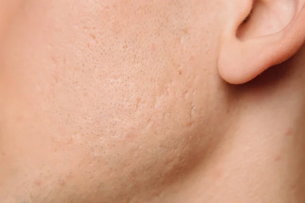 Primo Piano Della Pelle Problema Con Cicatrici Profonde Acne Sulla — Foto Stock