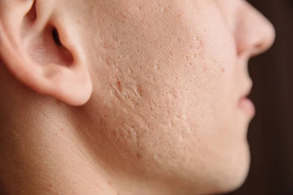 Close Problem Skin Deep Acne Scars Young Man Cheek — Stock Photo, Image