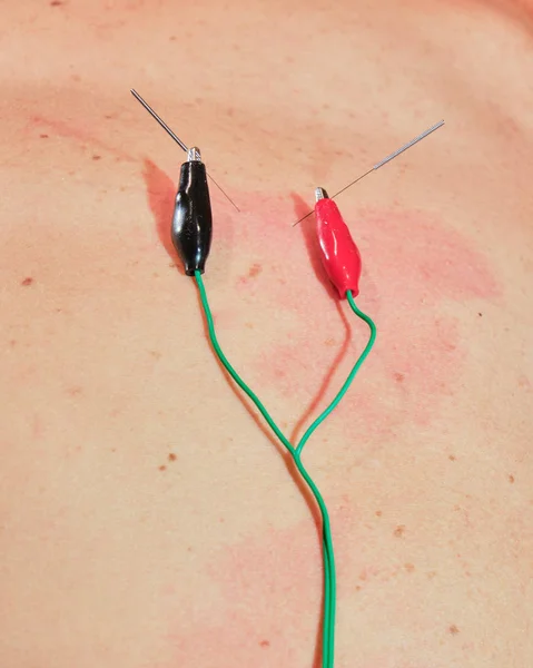 Acupuncture needles treatment with electrical wires / stimulator on Caucasian skin. Traditional Chinese acupuncture and modern Electro acupuncture concept.