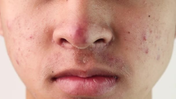 にきびと問題の肌を持つアジアの十代の男の顔を閉じてください 健康とスキンケアの概念 — ストック動画