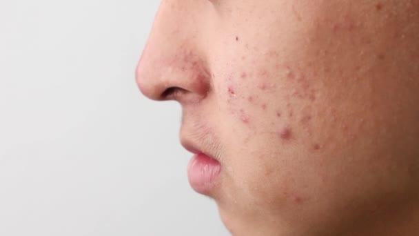 Close Van Het Gezicht Van Aziatische Tiener Jongen Met Acne — Stockvideo