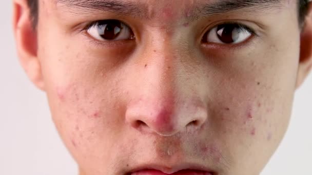 Close Gezicht Van Aziatische Tiener Jongen Met Acne Probleem Huid — Stockvideo
