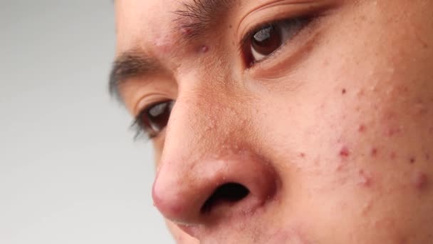 にきびと問題の肌を持つアジアの十代の男の顔を閉じてください スキンケアコンセプト — ストック動画