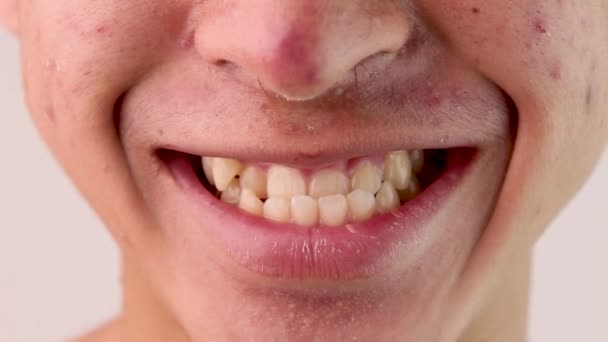 Rostro Cercano Del Adolescente Asiático Con Problema Estructura Dental Anormal — Vídeos de Stock