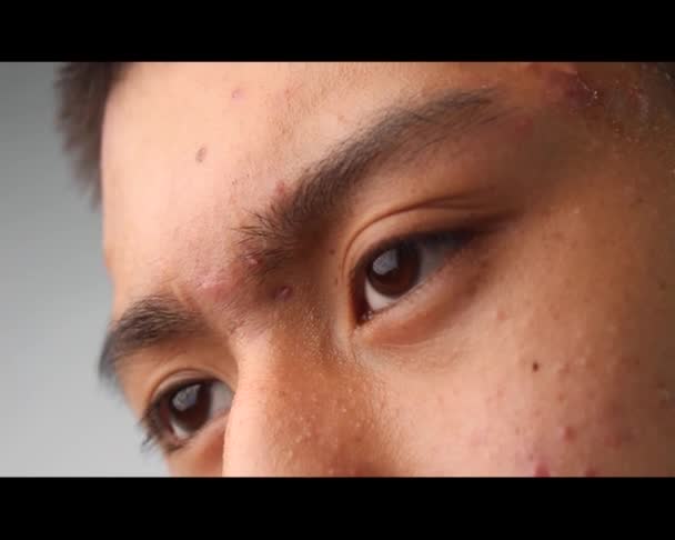 Close Rosto Adolescente Asiático Com Acne Pele Problema Conceito Cuidados — Vídeo de Stock