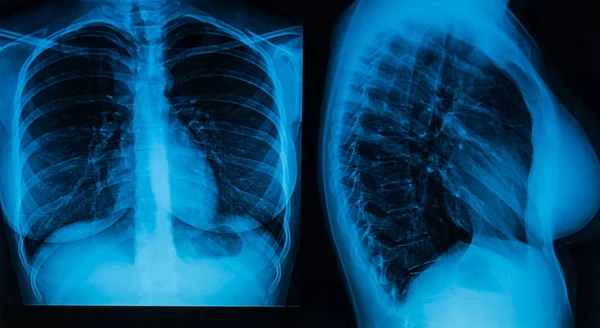 A woman\'s chest x-ray in two projections
