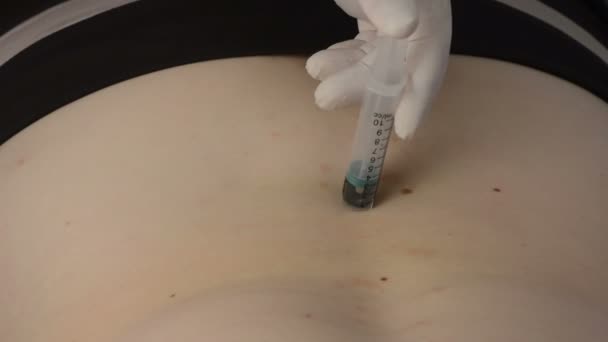 Handen i en handske gäller en medicinsk blodigel på huden på vita patienten — Stockvideo