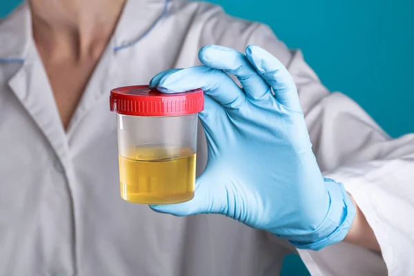 Beyaz önlüklü ve mavi eldivenli bir doktor elinde plastik bir kutu idrar tutuyor. Virüs, alkol, hamilelik, uyuşturucu ve hastalıklar için idrar testleri