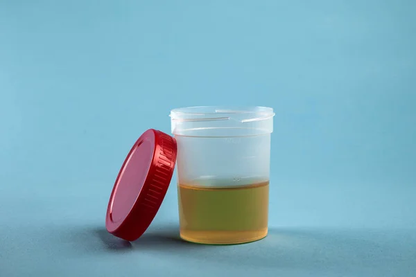 Plastik kavanozdaki bir test için idrar analizi.
