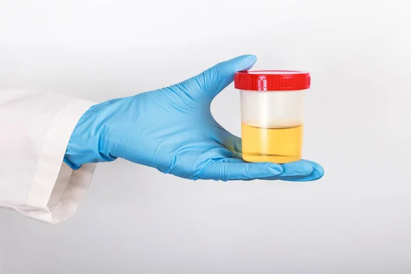 Doktorun eldivenli elinde idrar testi yapılan tüp.