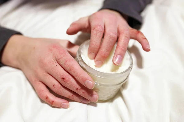 A young child is applying moisturizing lotion to his extremely cracked and dry skin on his hands.