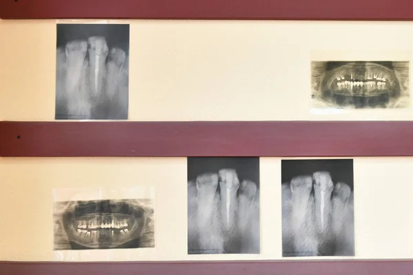 x-ray of teeth. problem teeth. a problem with the teeth. reception at the dentist