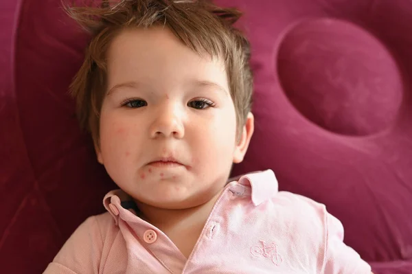 Retrato Uma Criança Com Uma Erupção Cutânea Rosto Herpes Uma — Fotografia de Stock