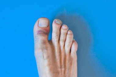 Mavi arka planda büyük ayak parmağı hasar görmüş..