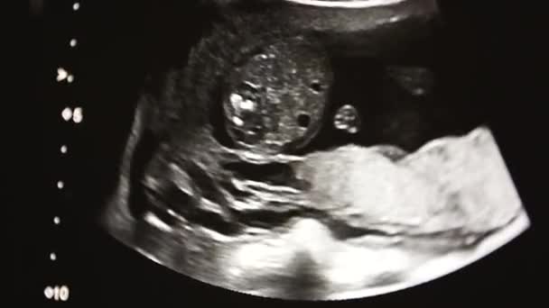 Ecrã Máquina Ultra Som Com Coração Bebê Por Nascer Vista — Vídeo de Stock