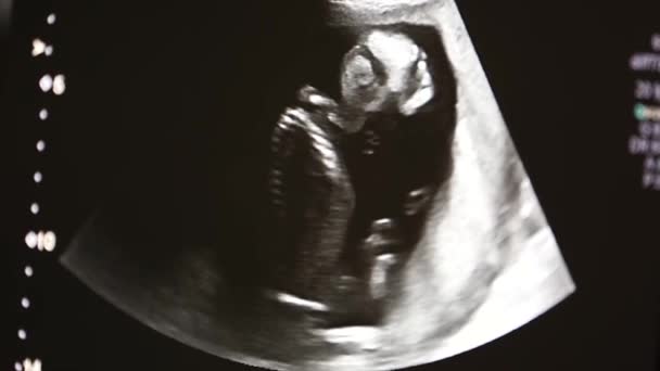 Ultrasound Machine Screen Unborn Baby Close View — ストック動画