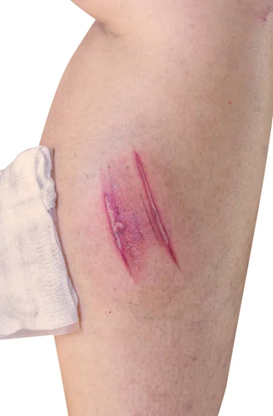 Lesão na perna de queimaduras horríveis — Fotografia de Stock