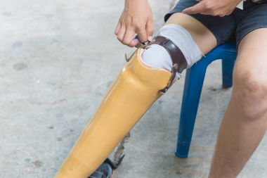 Yeni alüminyum protez bacakları amputee hasta için