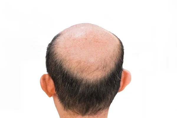 Glabrous pada pria botak kepala terisolasi di latar belakang putih — Stok Foto