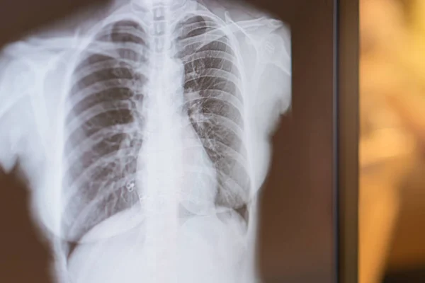 Рентгеновское Изображение Легких Пациентов Опухолью Легких Раком Легких Пневмонией — стоковое фото