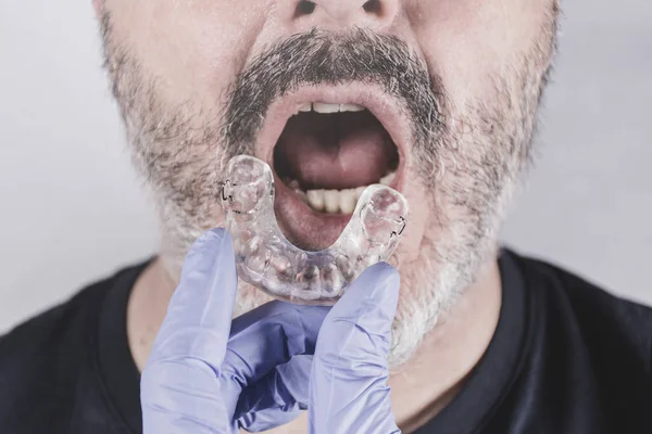 Hand Blue Glove Holding Dental Splint Facing Adult Man His — Stock Photo, Image