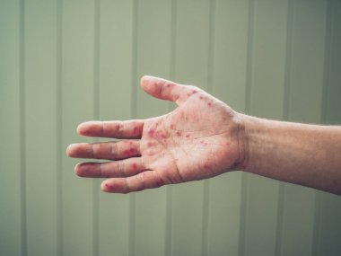 El ayak ve ağız hastalığı olan genç adam