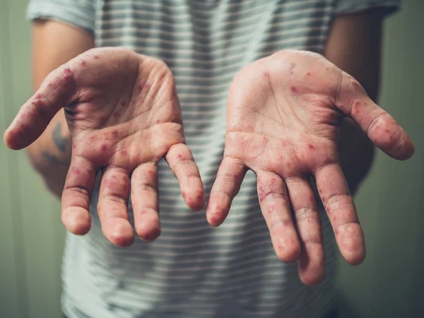 手手足口病を持つ若者 — ストック写真