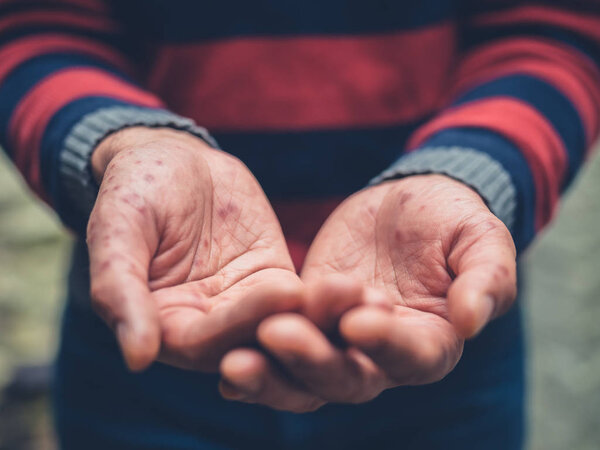 Close up on a man with spots on hands begging