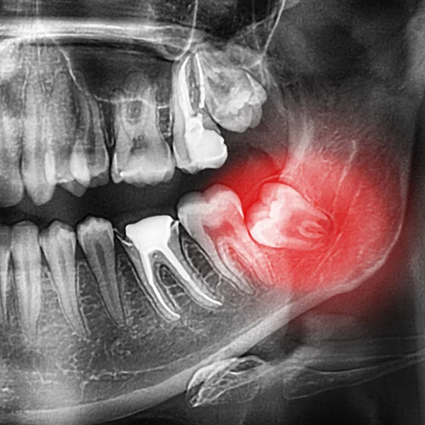 Radiographs Teeth Orthopantomogram Dentition Lower Wisdom Teeth Eighth Teeth Tilted — Stock Photo, Image