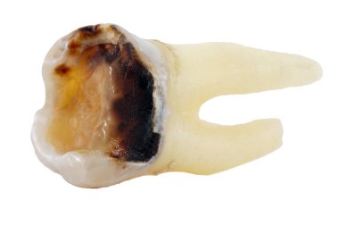 Çıkarılan dişler beyaz arka planda izole edilmiş, yakın plan makro, düşük azı dişi