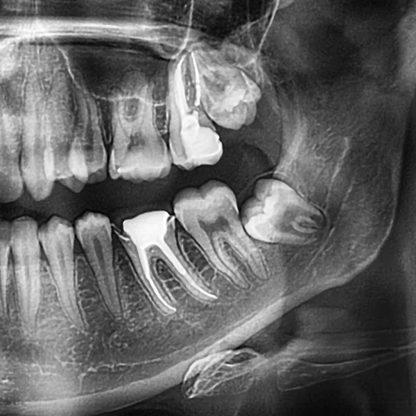 Рентгеновские Снимки Зубов Ортопантомограмма Зубов Нижние Зубы Мудрости Восьмые Зубы — стоковое фото