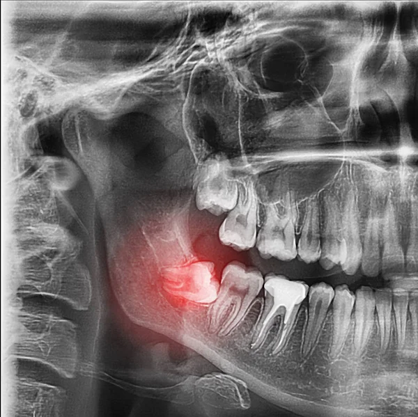 radiographs of the teeth, orthopantomogram of the dentition, the lower wisdom teeth are the eighth teeth are tilted, dystopia, polurethane, retention, x-ray, pathology, complex wisdom teeth