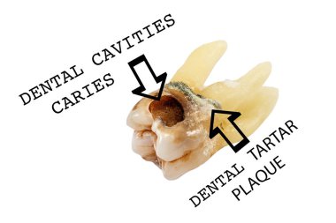 Beyaz arka planda izole edilmiş patolojinin gösterimiyle çekilen dişler yakın plan makro, üst azı dişi